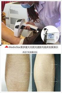 脱毛机脱毛视频,视频揭秘脱毛新潮流