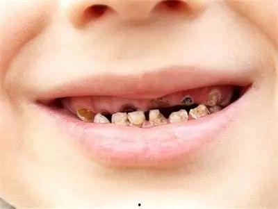 成人拔蛀牙视频文案,成人拔蛀牙全解析