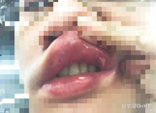 成人补牙视频推荐大全集