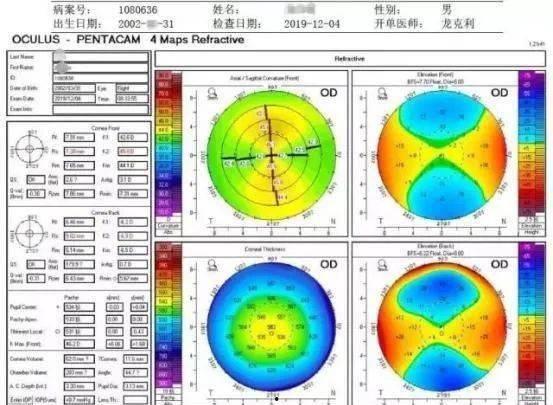 纠正成人散光的方法视频,轻松掌握成人散光矫正技巧